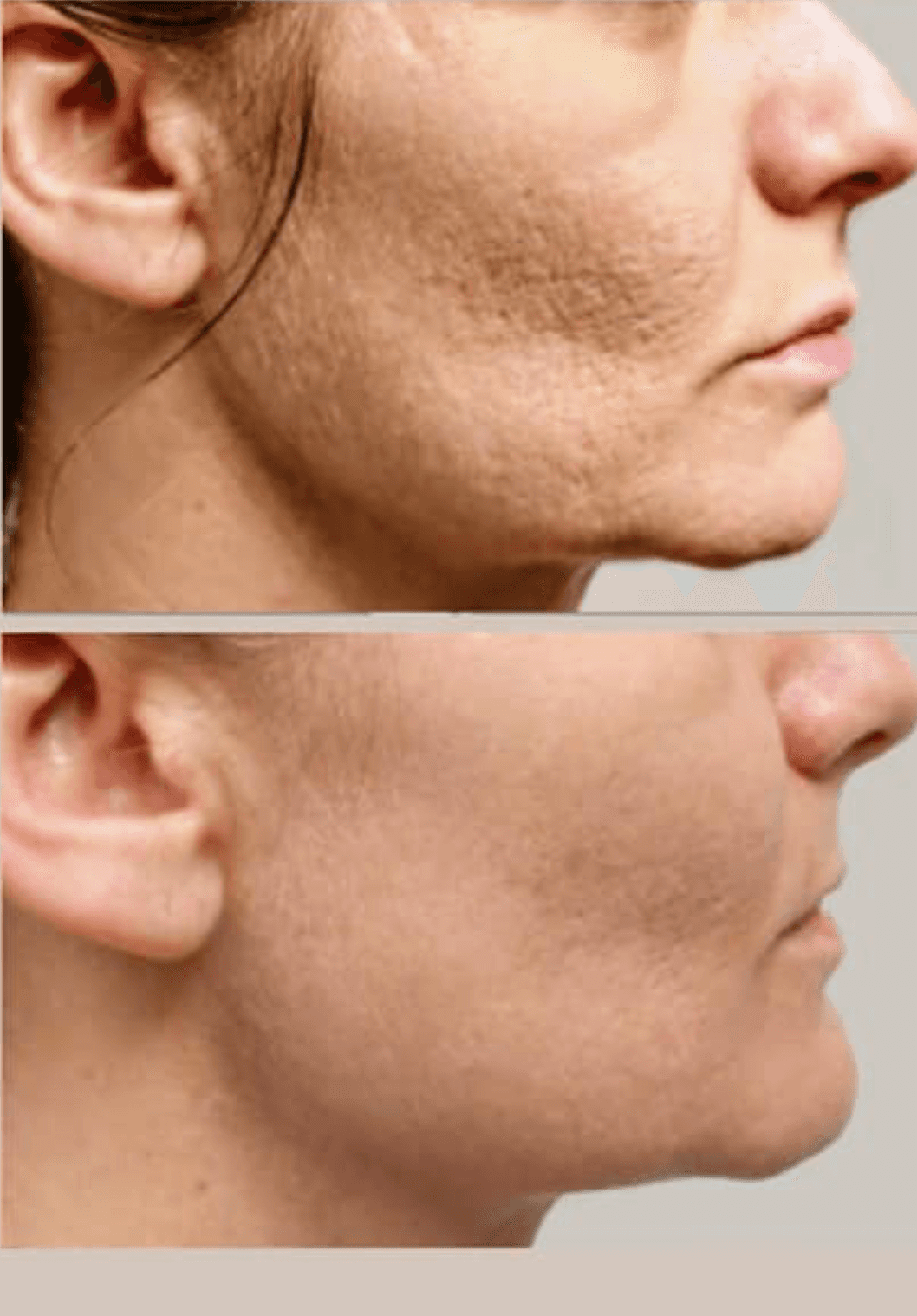 Scarlet SRF: The Next Generation of Skin Tightening and Scalp Lifting