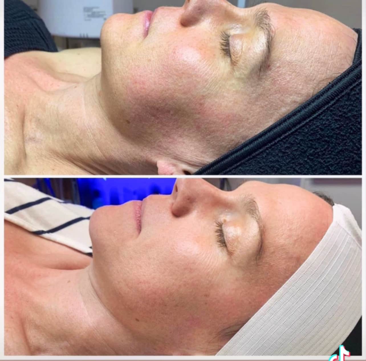 Scarlet SRF: The Science of Non-Surgical Skin Tightening at EXOTICA SKIN CARE 