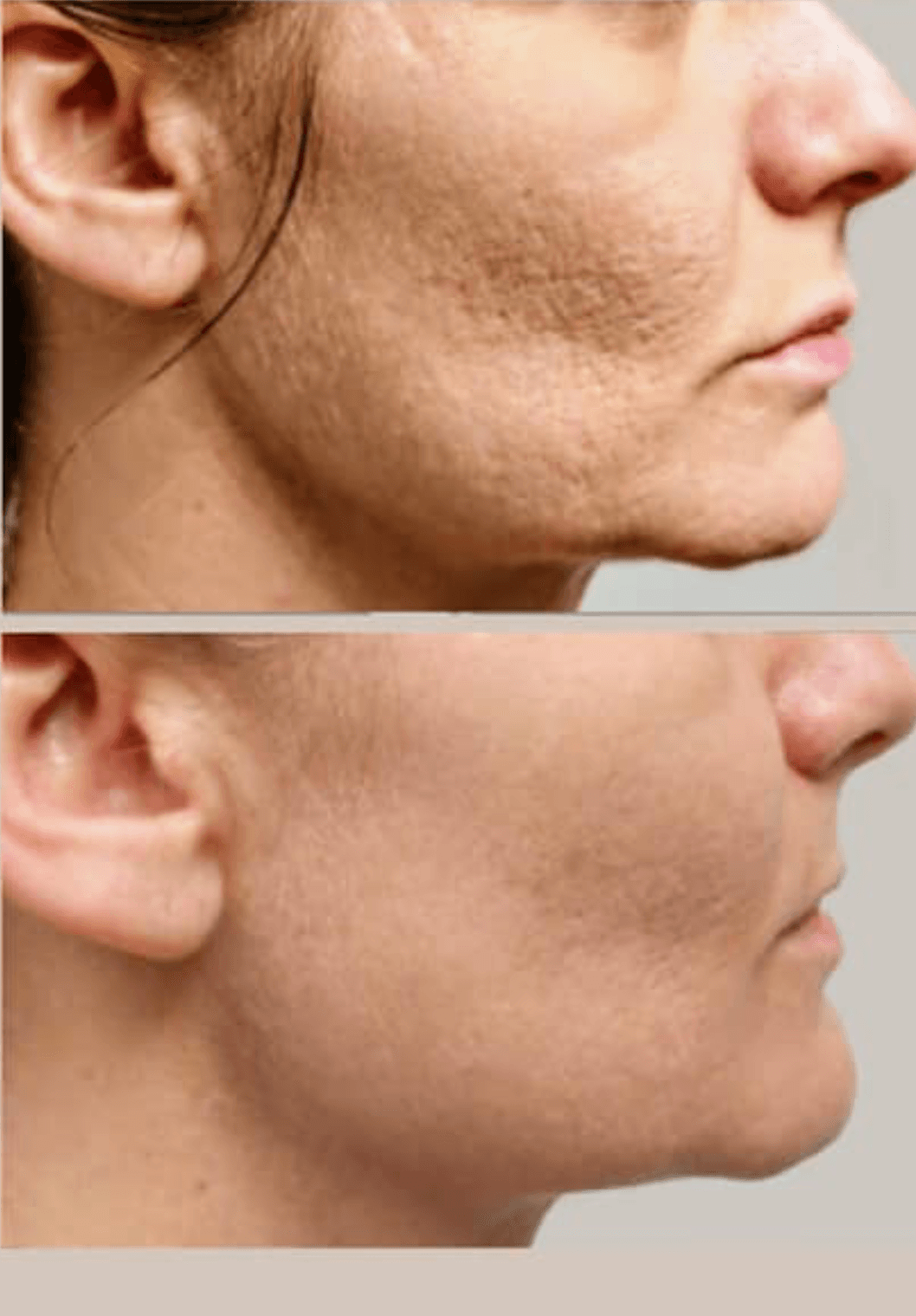 Scarlet SRF: The Next Generation of Skin Tightening and Scalp Lifting